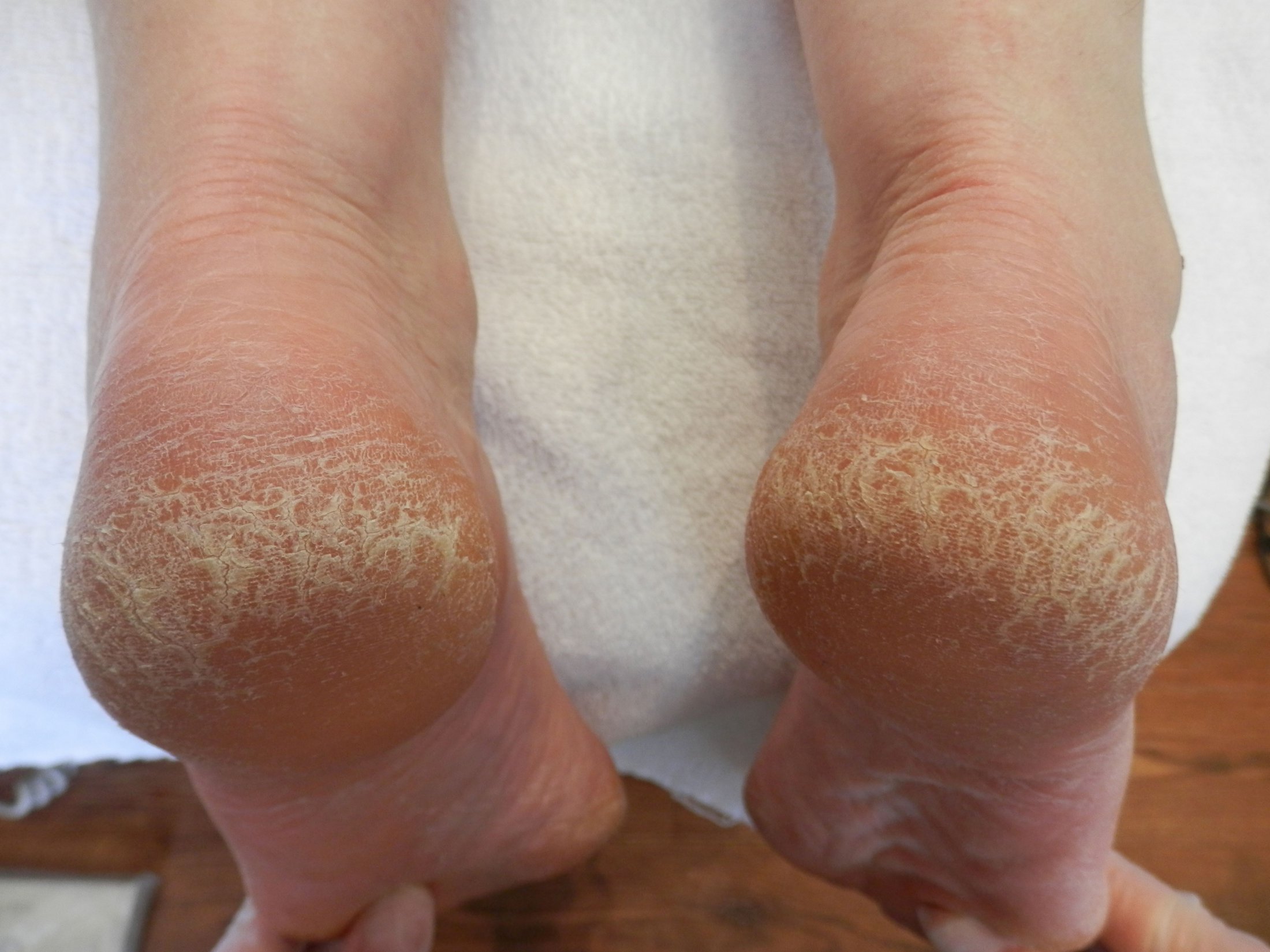 Cracked skin on hot sale sole of foot